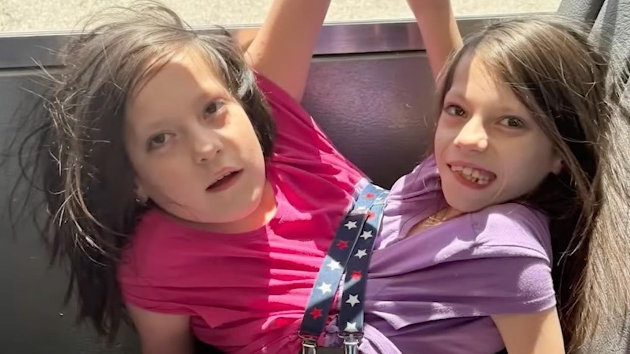 HT4. Mother of conjoined twins given just 24 hours to live reveals why she refused to separate them