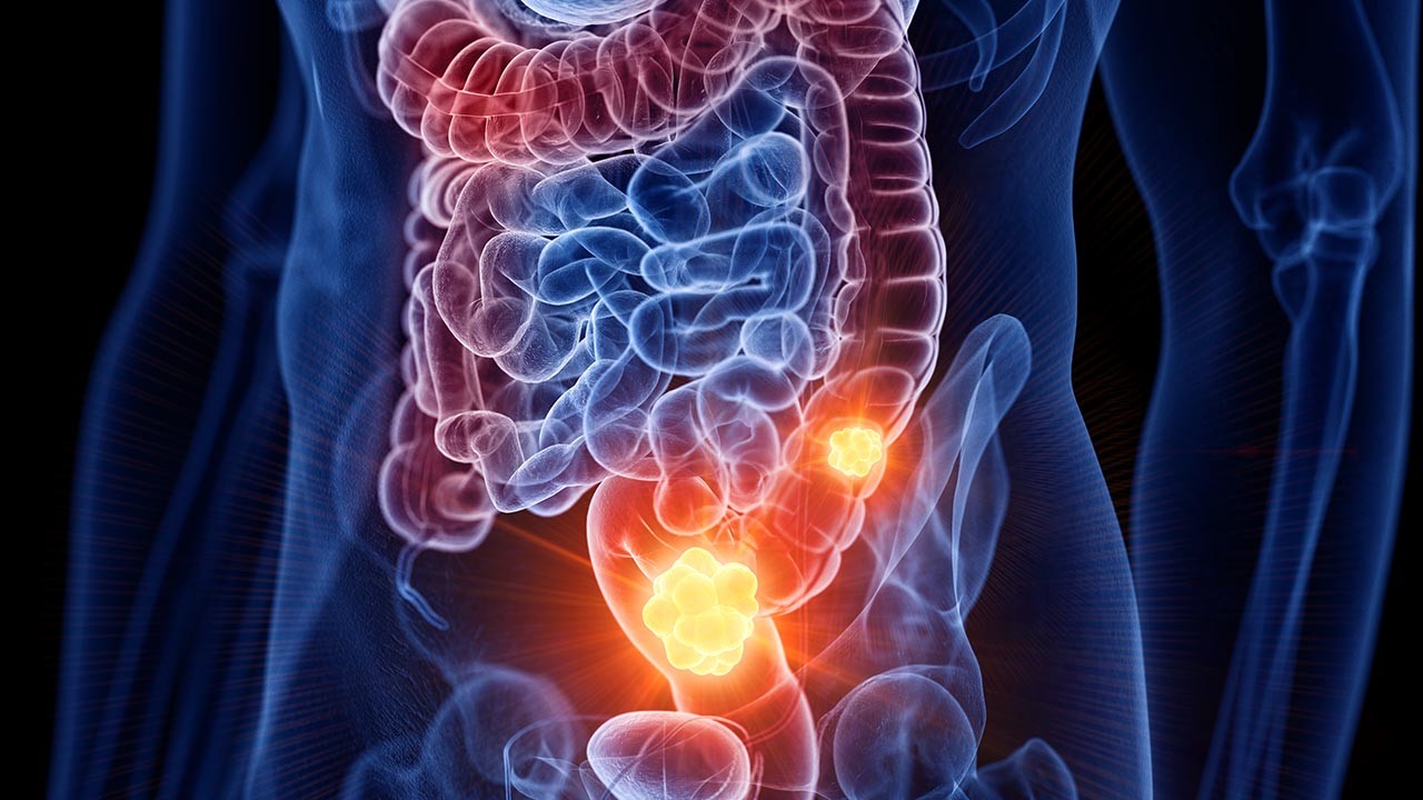 HT2. Oncologist who cut open people for 17 years saw the same foods in 80% of colon cancer patients
