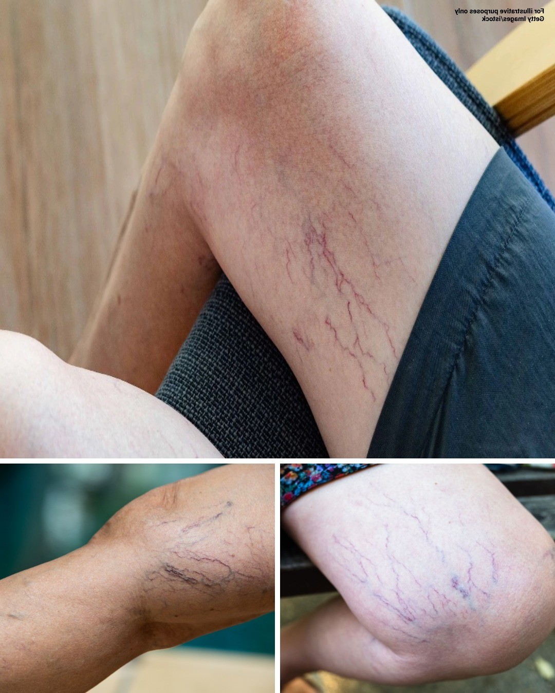 HT1. If you have purple veins on your legs, it means you are…