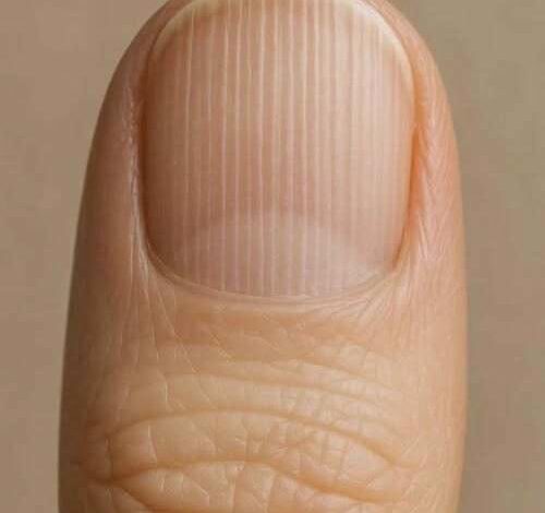 HT1. Your Fingernails Are Trying to Warn You of a Hidden Danger, But You’re Ignoring the Most Critical Clues