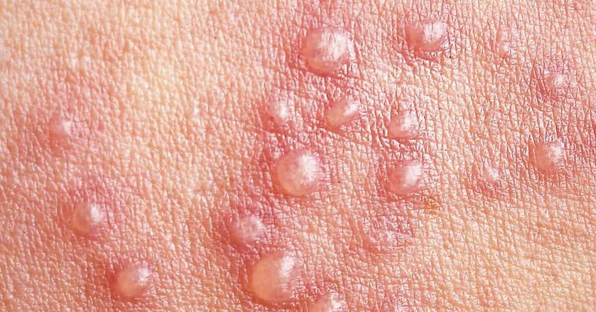 HT1. Shingles: The Virus That Sleeps For Decades and Strikes Without Warning