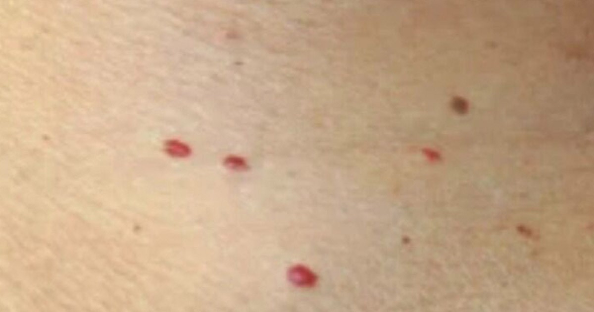 HT1. 11 Reasons Why You Have Red Dots On Your Skin
