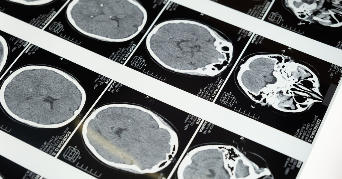 HT2. Alzheimer’s Brain Changes Begin 7 Years Before Plaques Even Appear