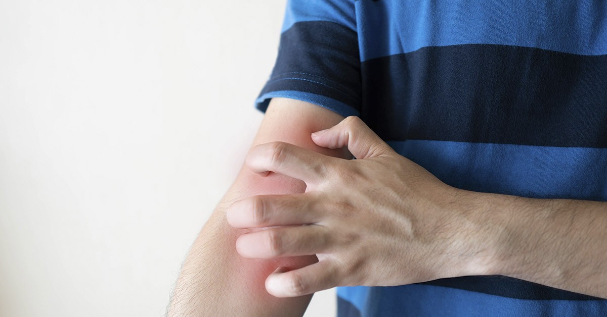 HT3. Itchy Red Spots on Your Skin? Don’t Ignore This Common but Misunderstood Condition