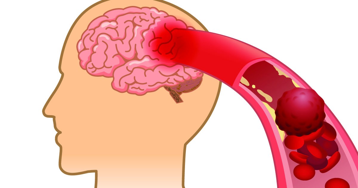 HT2. 10 signs your arteries might be clogged