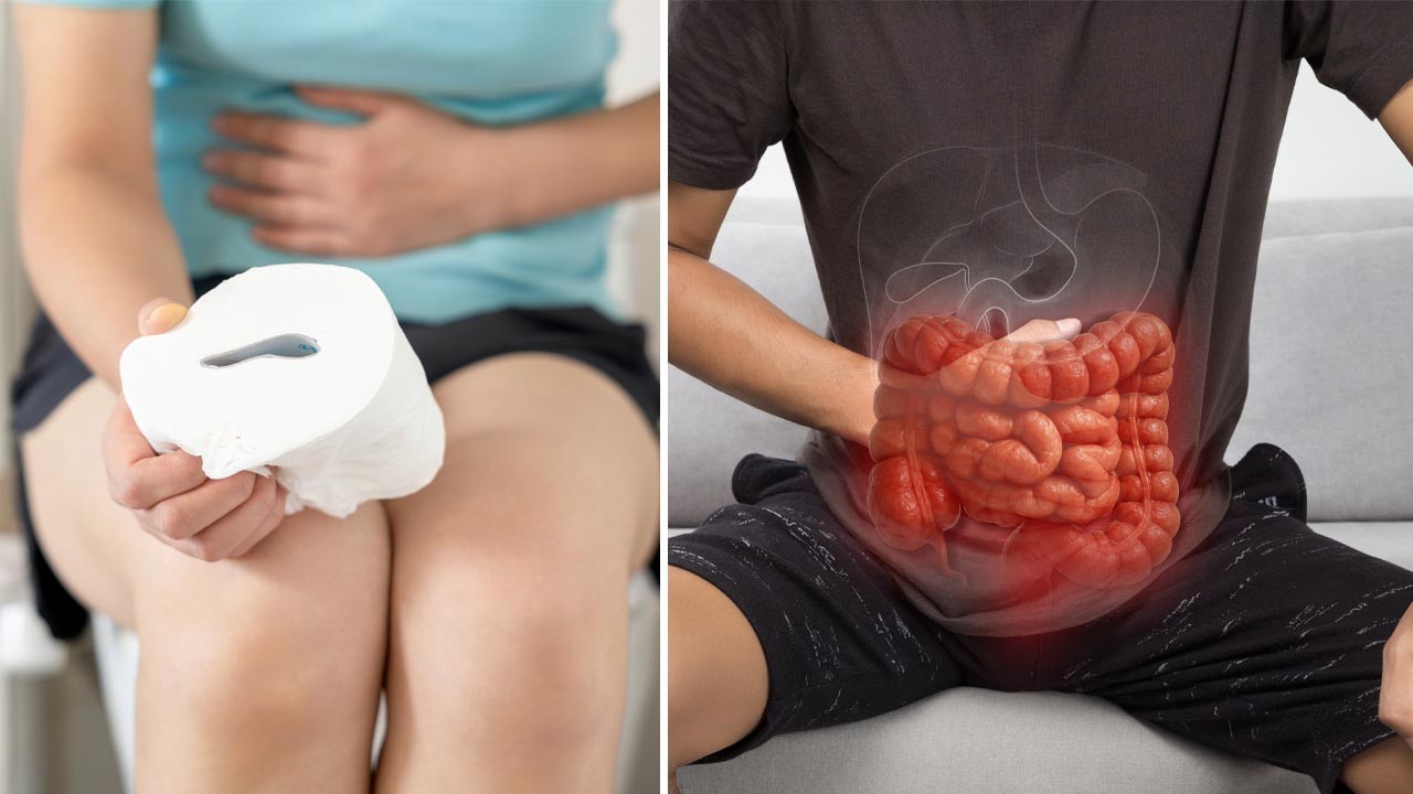 HT2. Doctor reveals key warning sign that could indicate stomach problems are actually bowel cancer