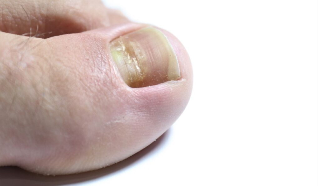 HT1. Health Issues Hidden in Your Nails, Revealed by Doctors
