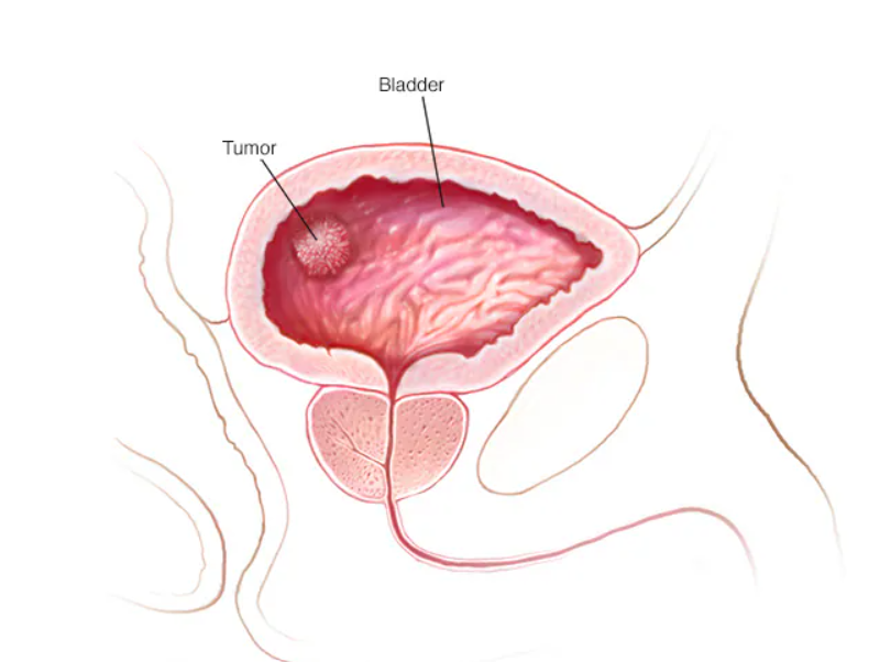 HT1. Before diagnosis, bladder cancer survivors all shared this single most common early sign –