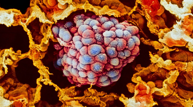 HT2. Low-cost deworming agent investigated as potential therapy for drug-resistant lung cancer –