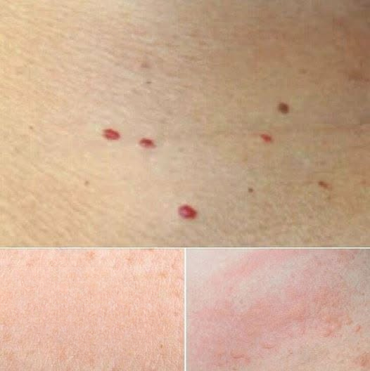 HT1. Red Dots on Your Skin: Common Causes and When to Seek Medical Advice