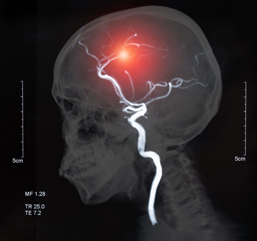 HT1. 12 signs that may signal a brain aneurysm — Don’t ignore them –