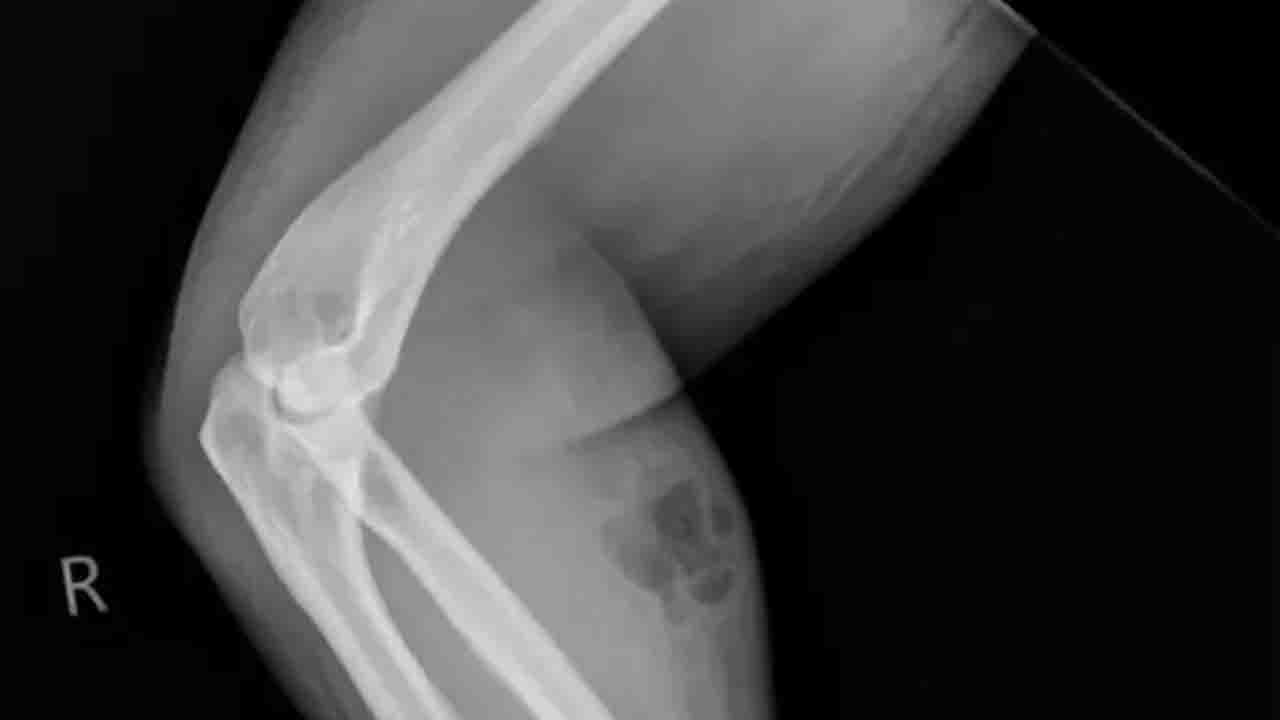 HT4. Man injected himself with his own semen for 18 months to cure back pain before discovery